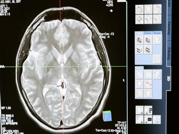 Blood tests in newly brain-injured patients predict death, severe disability