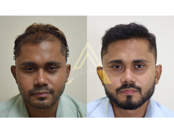 FUE Hair Transplant in Delhi FUE Hair Transplant Treatment in Delhi