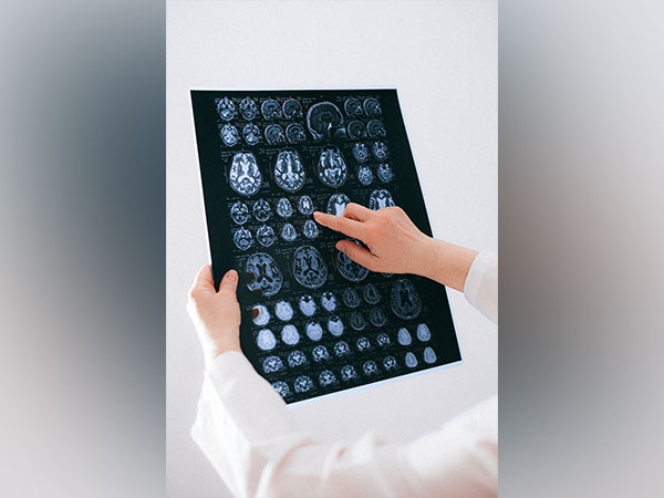 Study suggests how MRI shows brain changes in patina post-COVID