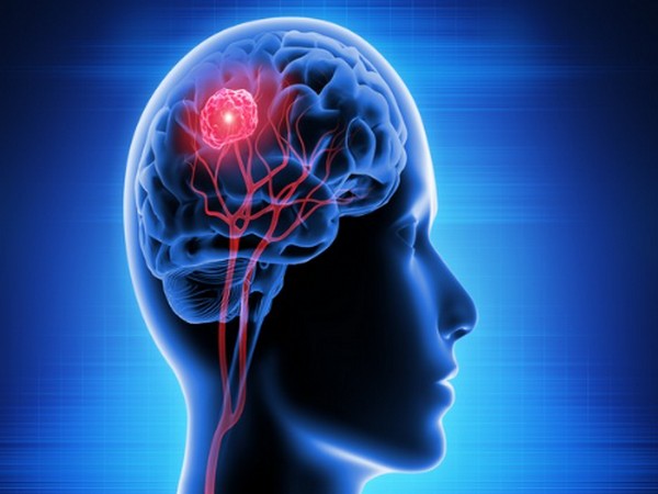 Genetic malfunction of brain astrocytes triggers migraine: Study Genetic malfunction of brain astrocytes triggers migraine: Study