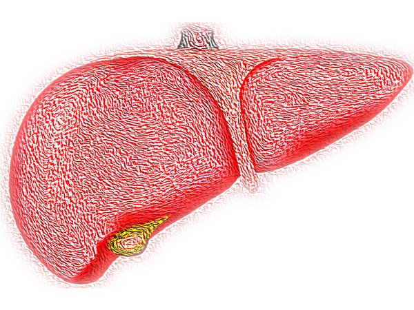 First-degree relatives of patients with NAFLD at risk of liver disease: Research First-degree relatives of patients with NAFLD at risk of liver disease: Research