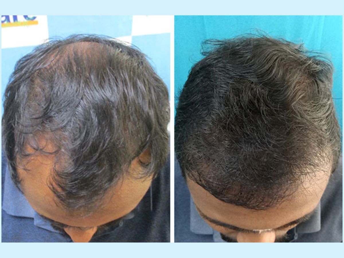 VCare's Hair Transplantation Ensures To Completely Reverse Baldness