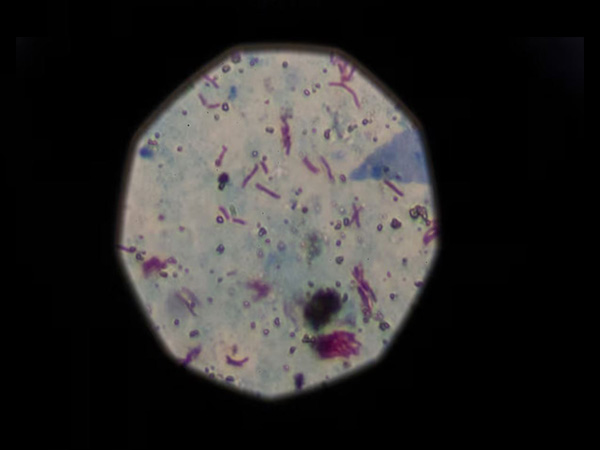 A sample that tested positive for tuberculosis is seen from a microscope (Image/Reuters)