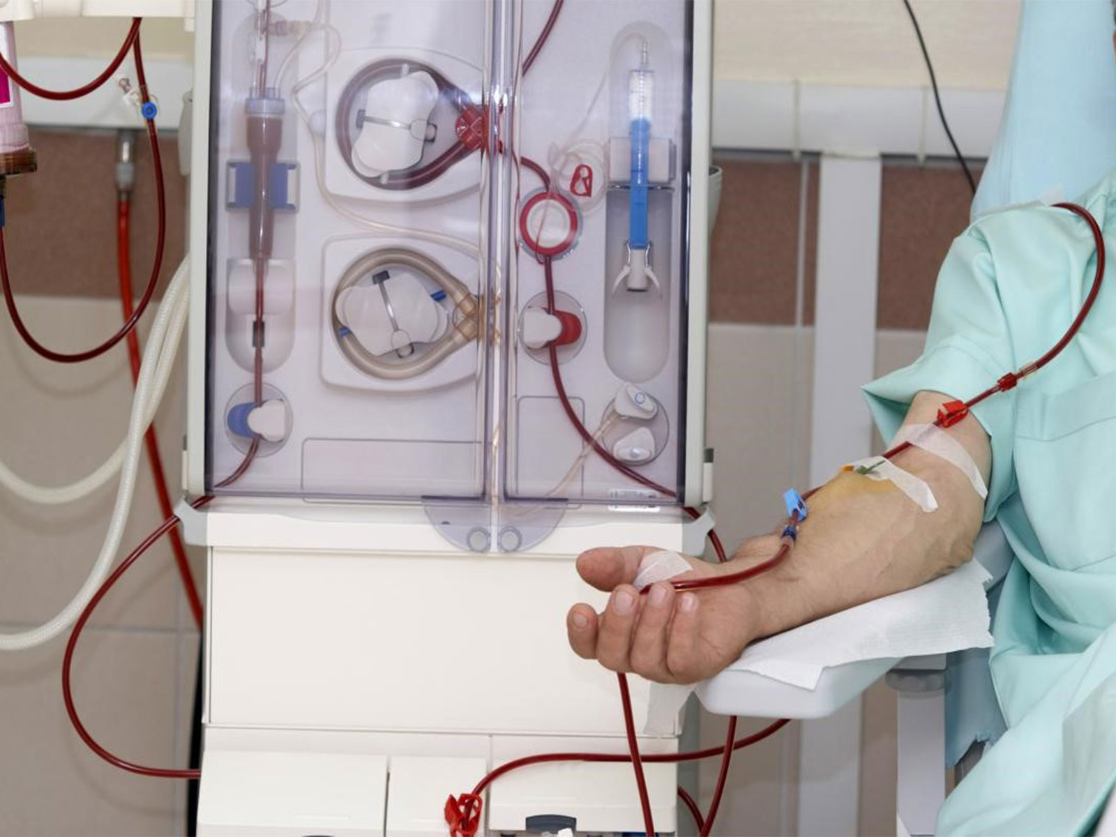 How Kidney Dialysis Is Done: Step-by-Step Overview for Beginners