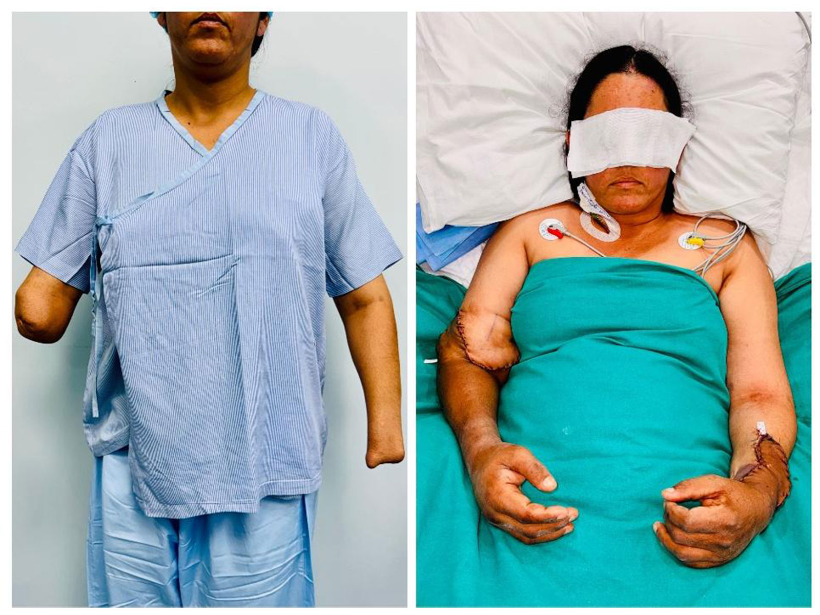 Hand Transplant gives new life to mother (Photo/ANI)