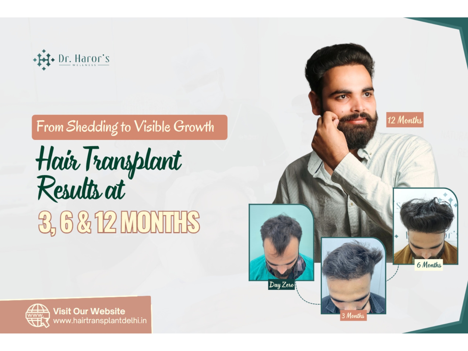 From Shedding to Visible Growth: Hair Transplant Results at 3, 6 and 12 Months