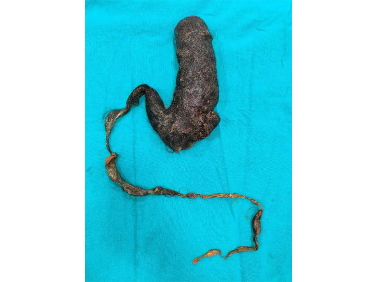 Hairball removed from woman's stomach (Photo/Amrita Hospital)