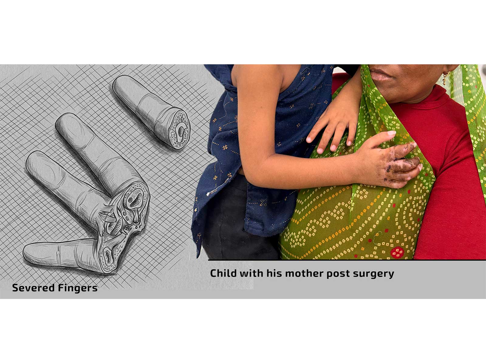 (L) Toddler's severed fingers after the accident & (R) Boy with his mother post finger-reconstruction surgery