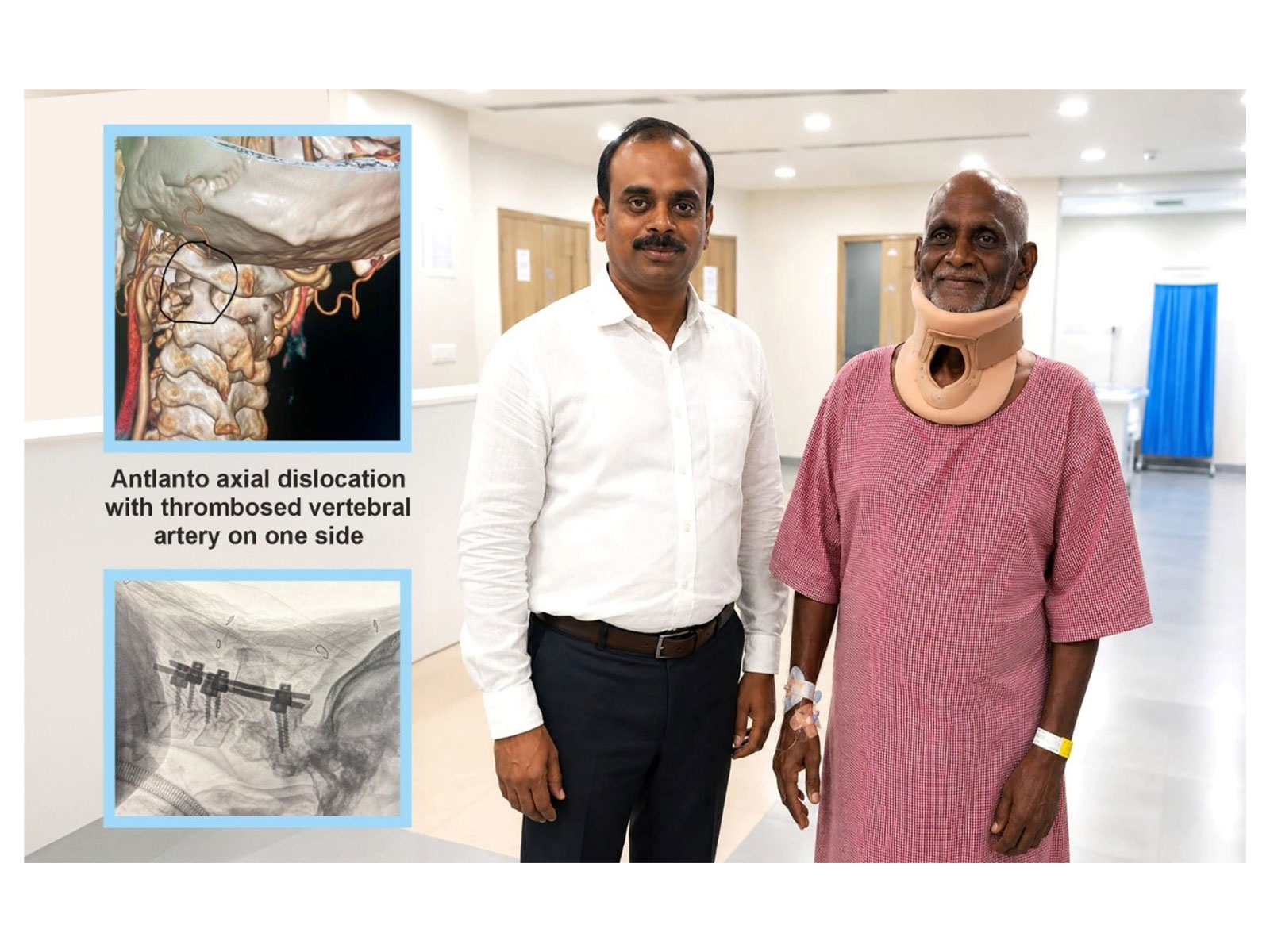Complex craniovertebral junction fixation performed by Dr. Shighakolli Ramesh highlights critical diagnostic gap in elderly trauma patients