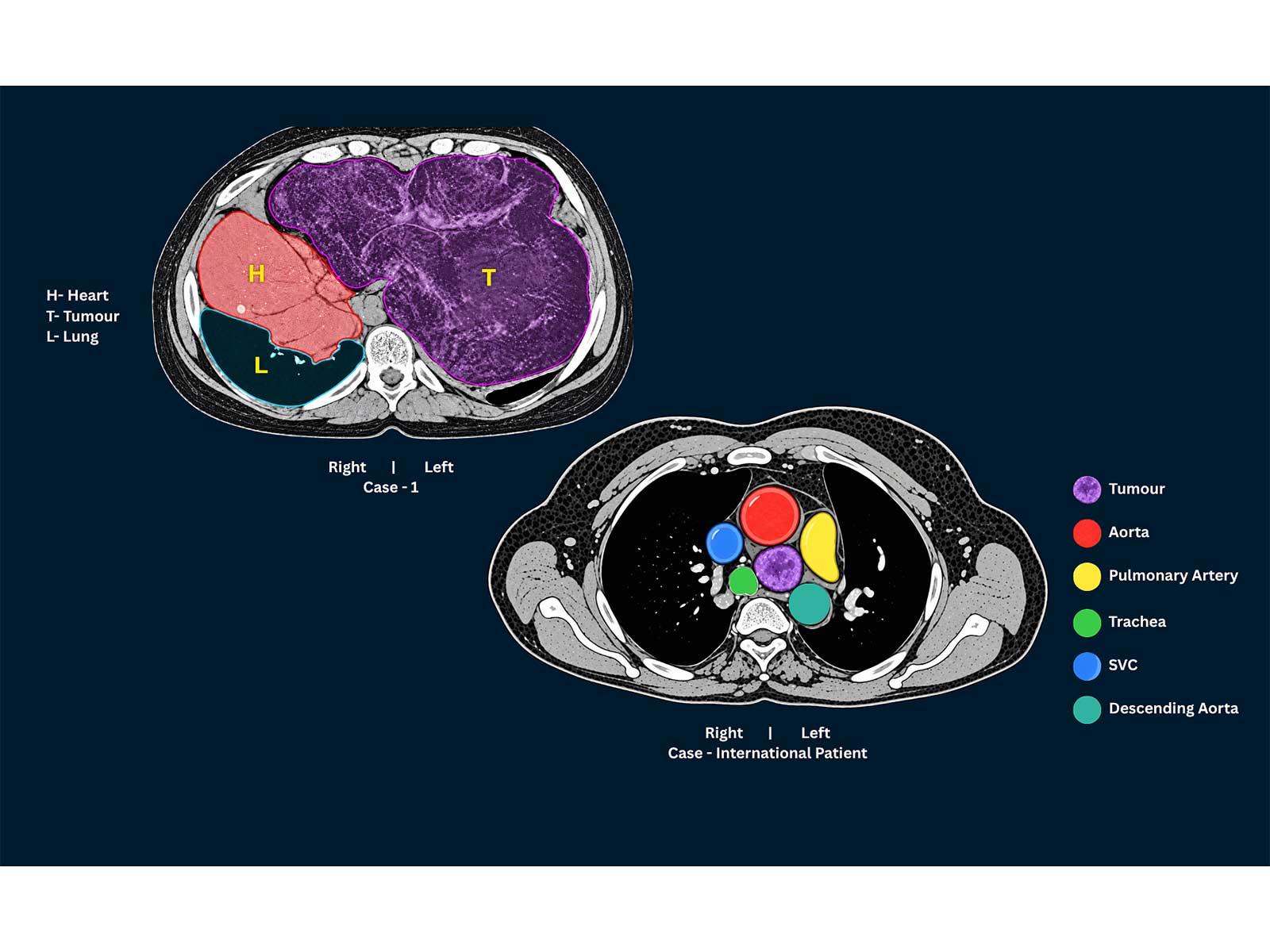 (L) Case 1: CT scan image showing tumour that has pushed the heart to the right (R) Case (International pt.): CT scan image highlighting the tumour and surrounding vessels
