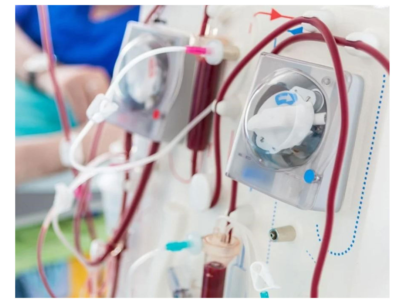 When Does Chronic Kidney Disease Require Dialysis? Signs and Treatment Options