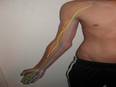 Pseudoaneurysm with median nerve injury caused by right radial artery puncture: Study - Vimarsana News