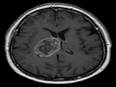 Study highlights importance of routinely imaging brain tumour patients - Vimarsana News