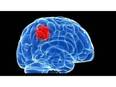 Brain imaging predicts PTSD after injury, finds study - Vimarsana News
