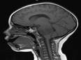 Common brain malformation traced to its genetic roots: Study - Vimarsana News