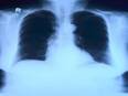 AI tool uses chest X-ray to differentiate worst cases of COVID-19: Study - Vimarsana News