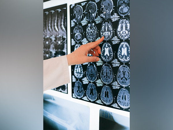 AI algorithm that recognizes anomalies in brain may help treat epilepsy