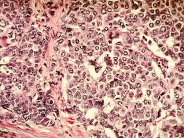 Scientists develop a new AI breast cancer diagnostic tool