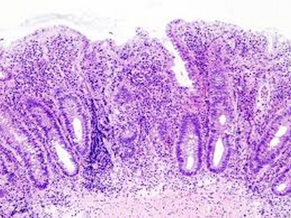 Ulcerative colitis Ulcerative colitis